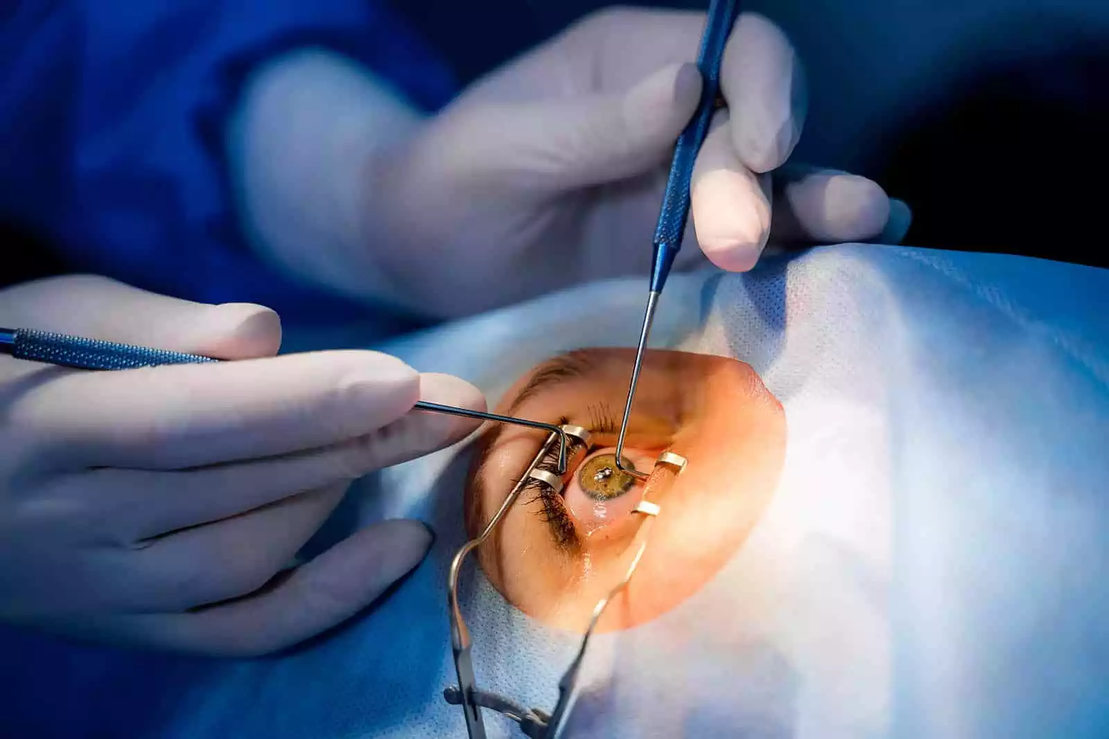 Vitrectomía y Reparación Retineal