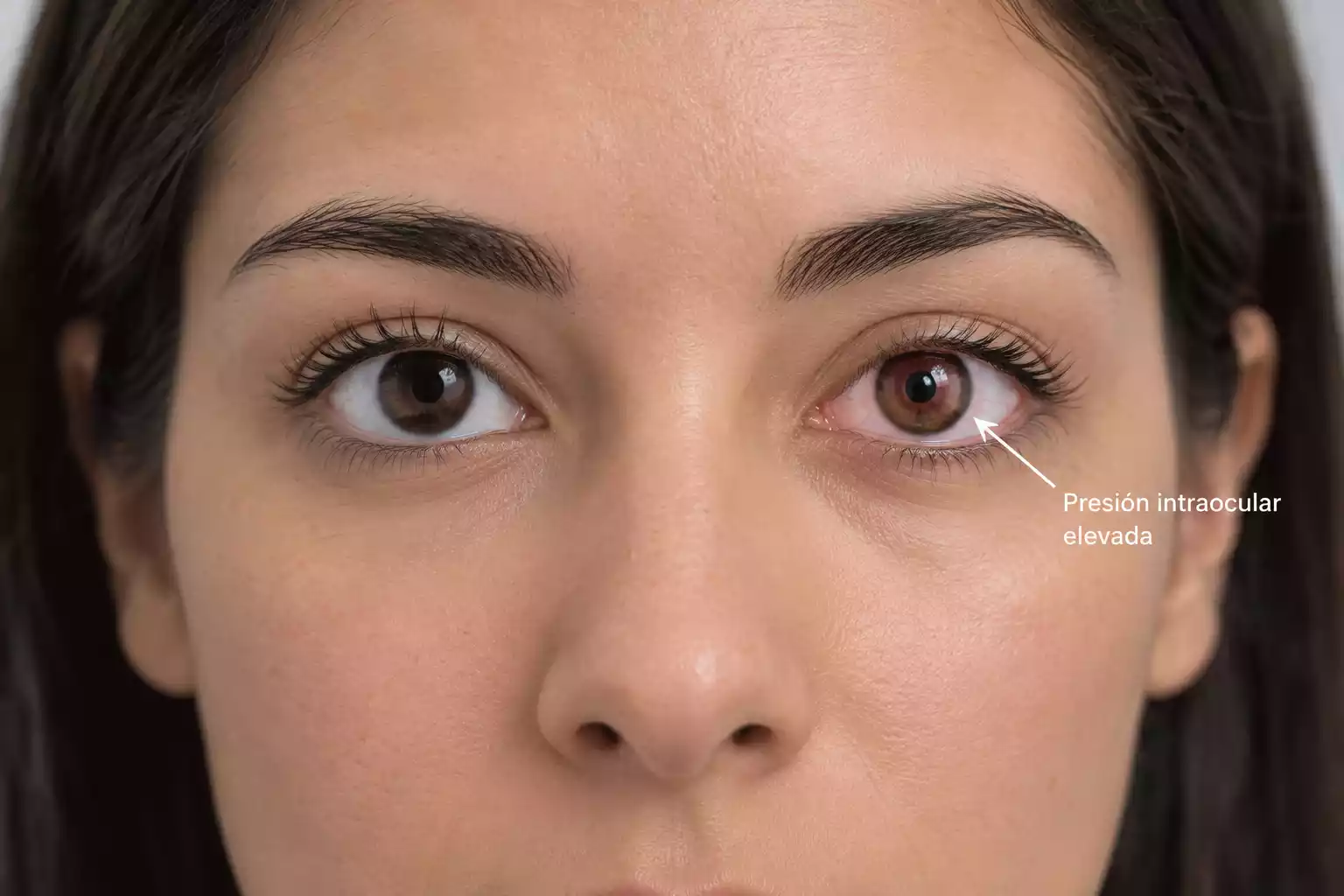 Tonometría Ocular y Medición de Presión Intraocular